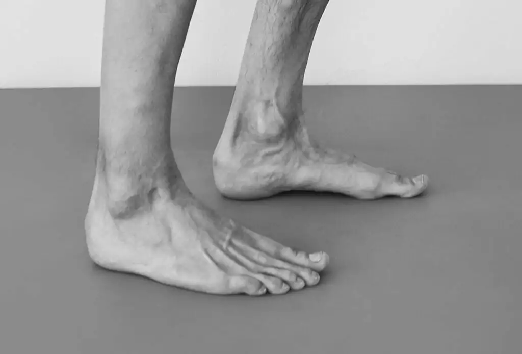 feet with bone spurs and high uric acid levels in the joint space